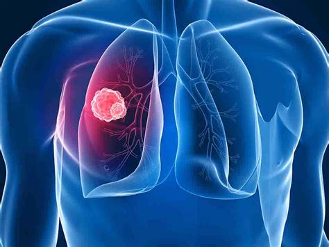 中心型肺癌晚期活多久