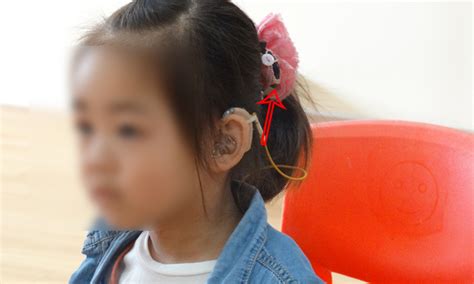 人工耳蜗丢失5岁女孩是谁找得到