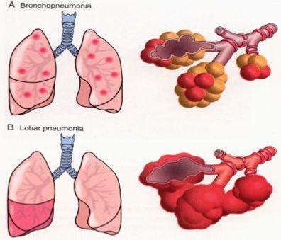 儿童大叶性肺炎洗肺有危险吗