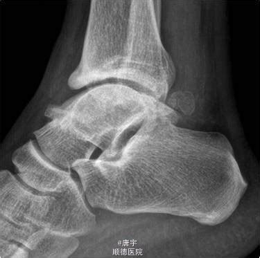创伤性踝关节炎可以戴护踝吗
