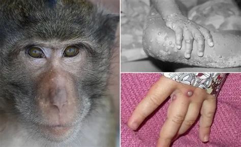 北京发现2例猴痘病