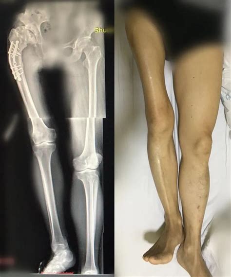 右腿骨折医生竟给左腿做手术
