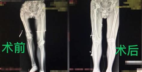 右腿骨折给左腿做手术