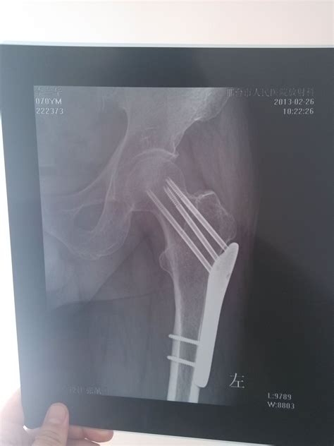 大腿骨折做手术五个月突然痛