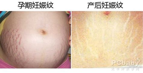 女人产后妊娠纹图片