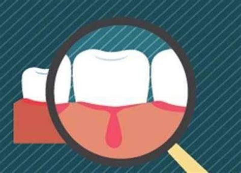 孕20周牙龈容易出血