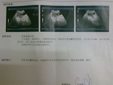 孕33周死胎