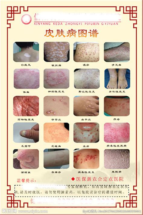 常见的几种皮肤病