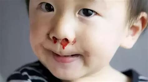 幼儿流鼻血的原因
