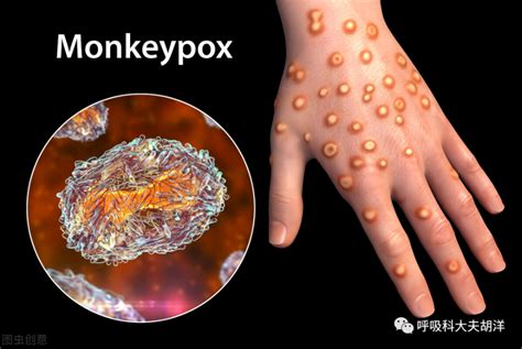 广州发现2例猴痘病例是怎么感染的