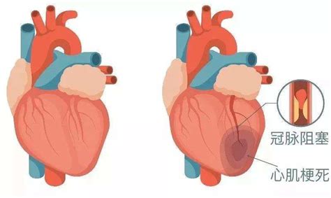 心脏室壁梗塞有什么症状