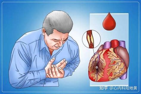 心脏梗塞前期需要注意什么