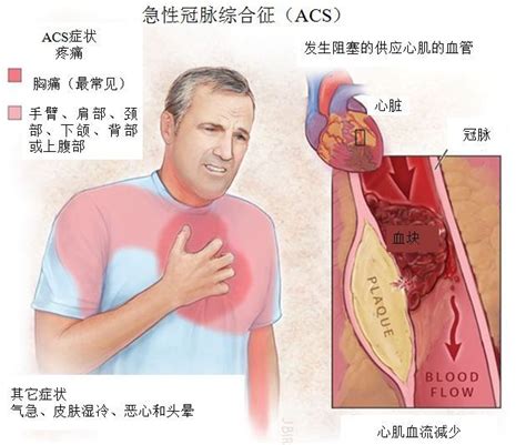 急性冠脉综合征的处理