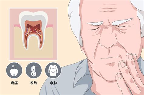 急性牙髓炎是几级疼痛
