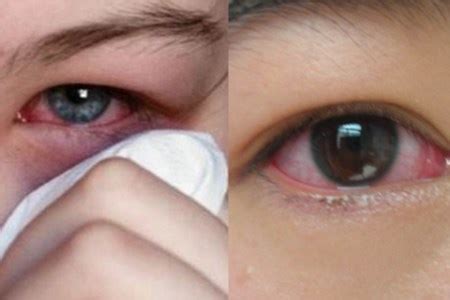 急诊能看眼睛发炎吗
