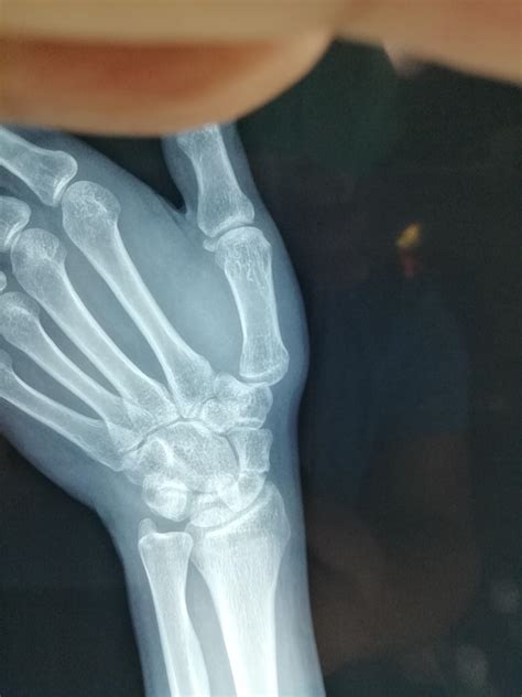 手腕骨折一般几个月恢复