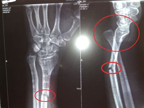 手腕骨折半个月恢复到什么地步