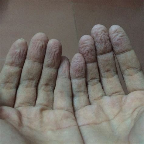 手遇水特别容易起皱而且脱皮