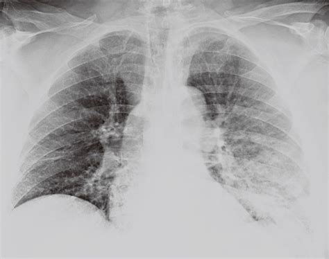 插管后肺部感染最严重的后果