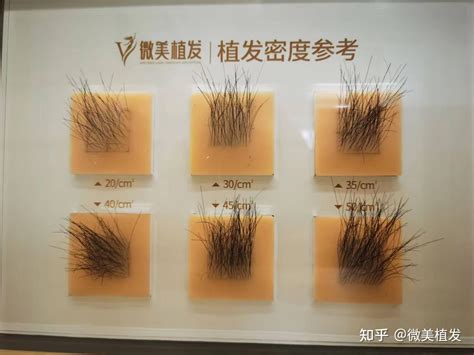 毛发种植的价格一般是多少钱