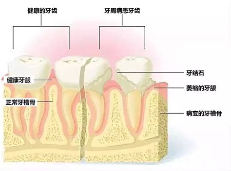 牙周炎为什么牙齿会掉光