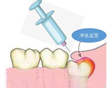 牙脓肿引流术多少钱