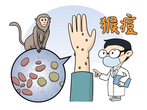 猴痘病毒中国最新情况