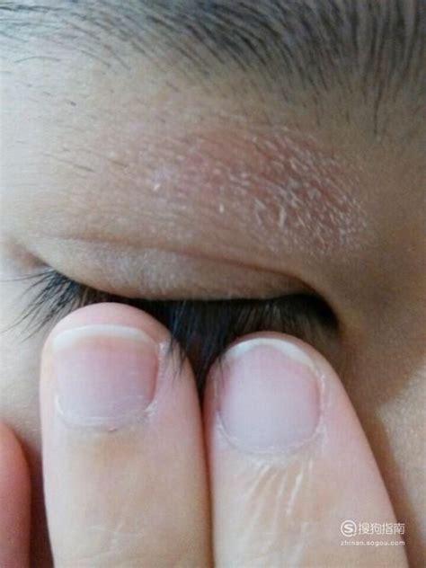 眼周皮肤过敏怎么处理