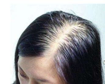 种植的头发有啥危害