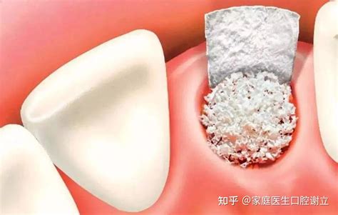 种牙增骨粉手术