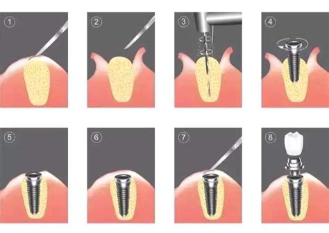 种牙过程图解