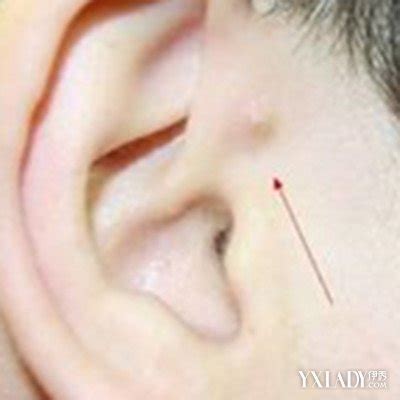 耳朵经常长痘什么原因