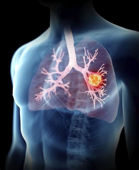 肺癌作为发病率最高的恶性肿瘤