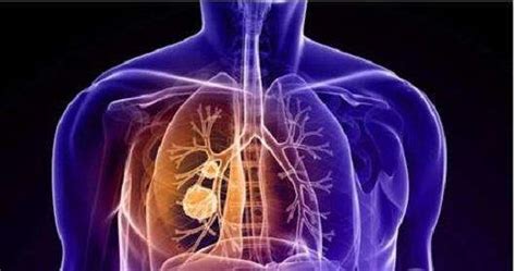 肺癌恶性度最高的癌症