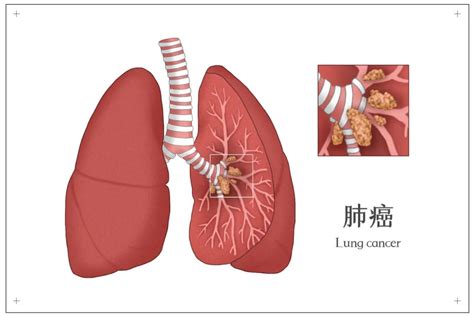 肺癌早期会传染人吗
