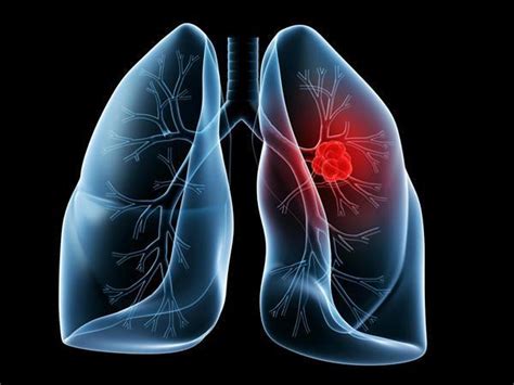 肺腺癌有良性的吗