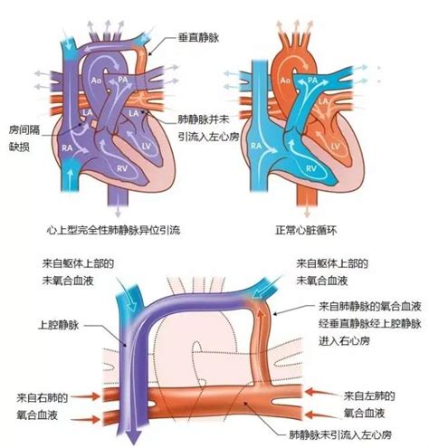 肺静脉异位引流如何手术