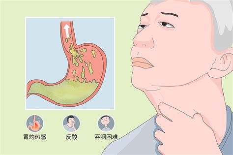 胃酸反流引起食管炎