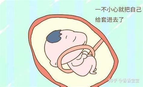 胎儿多少周容易脐带绕颈