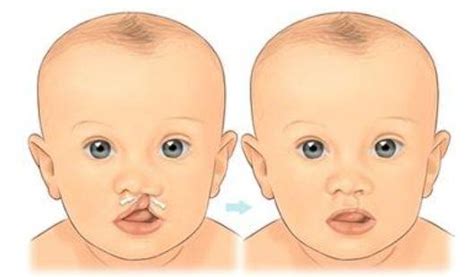 胎儿多少周查出唇裂的原因