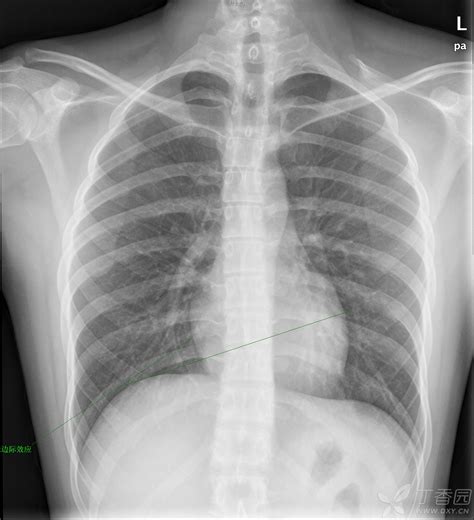 胸片怎么看肺有问题