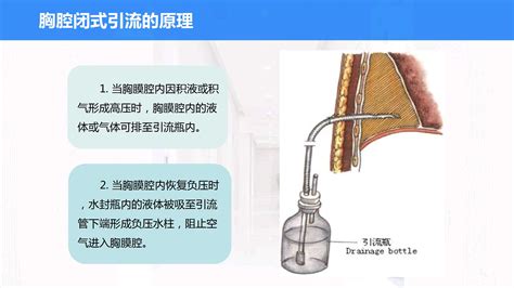 胸腔闭式引流管的处理