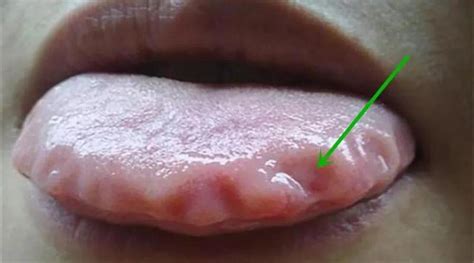 舌头两边有齿痕是怎么回事