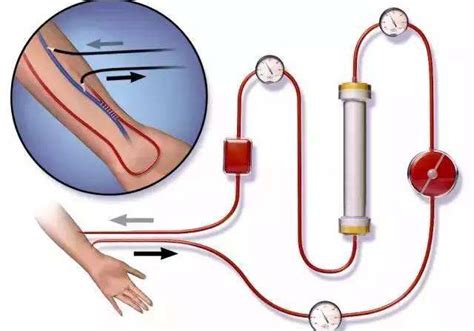 血液透析的血流量缩写