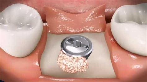 骨粉种植牙如何成型