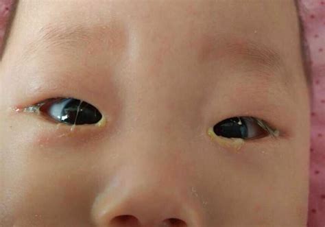 黄色衣服对婴儿眼睛有影响吗