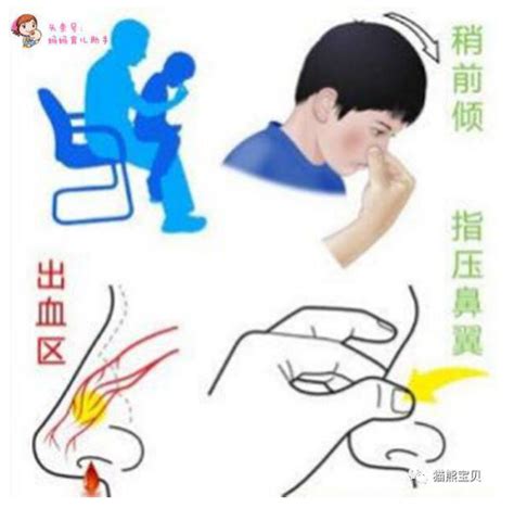 鼻出血的应急处理步骤