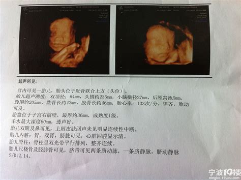 36周胎儿死胎的症状