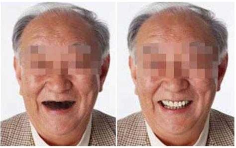 54岁的老人适合种牙