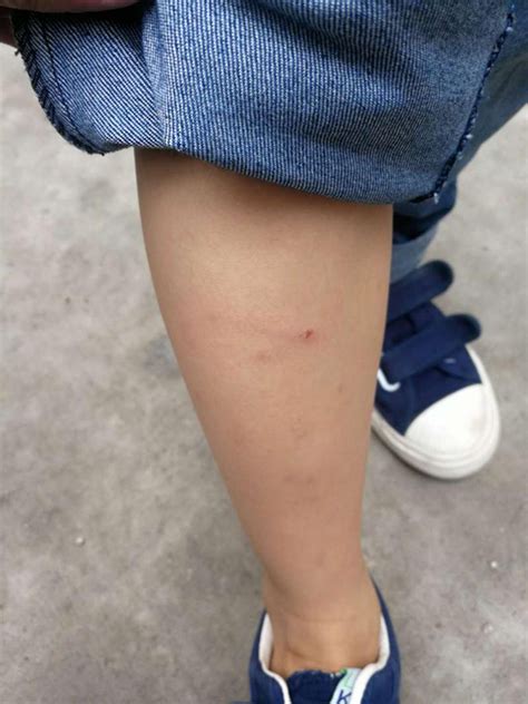 6岁男孩被狗咬伤缝了90针